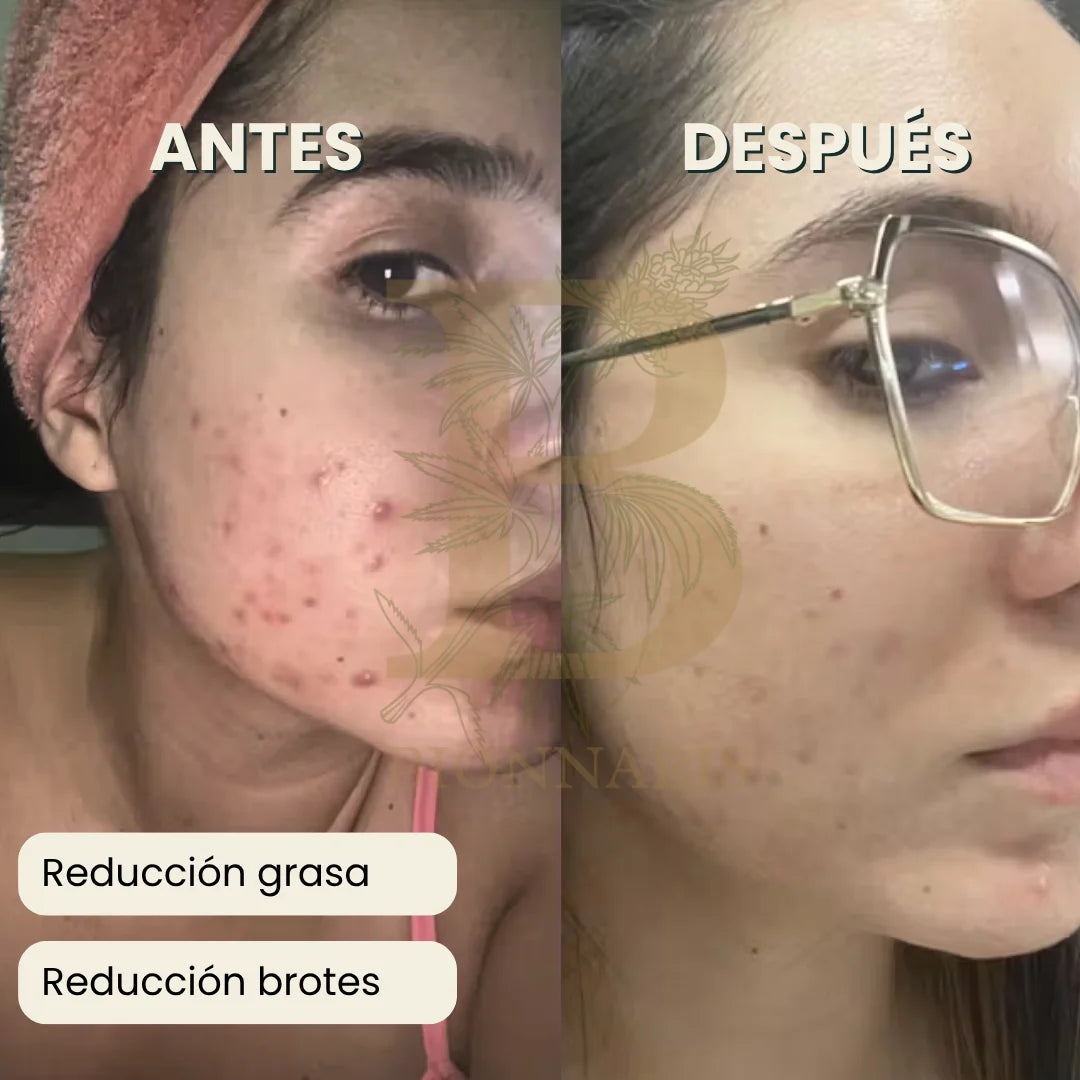 testimonio usando jabón antiacné