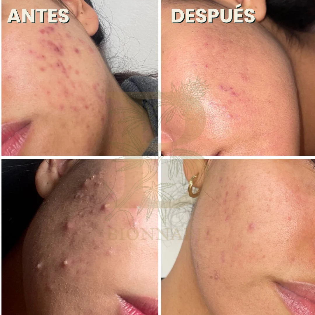 Testimonio real kit piel sana elimina el acné desde ña raíz- transformación de piel con acné usando jabón limpiador y sérum natural

