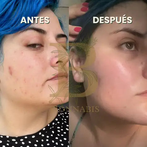 KIT ANTIACNÉ