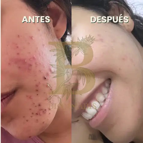 serumy. jabón antiacné