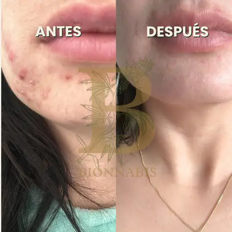 PIEL SIN ACNÉ