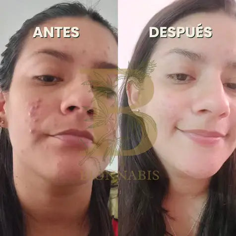 ANTIACNÉ