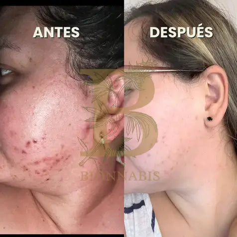 KIT ANTIACNÉ