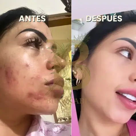 PIEL SANA SIN ACNÉ